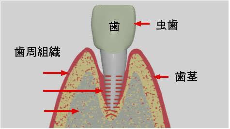 歯周病治療　歯茎